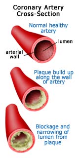 Coronary artery cross-section showing plaque build up and blockage.