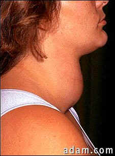 http://www.phoenity.com/diseases/images/thyroid_enlargement.jpg