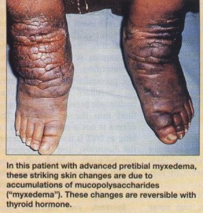 http://meded.ucsd.edu/isp/1994/im-quiz/images/myxedema.jpg
