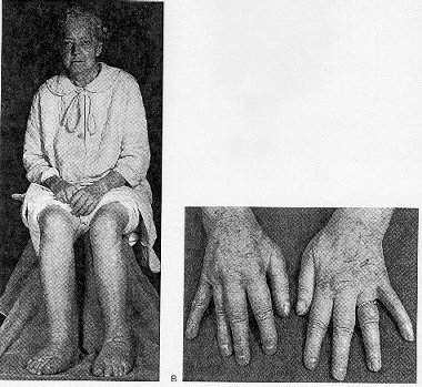 http://www.thyroidmanager.org/figures12/Fig.12-7ab.JPG