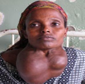 http://www.llu.edu/news/images/jun2906/goiter.jpg