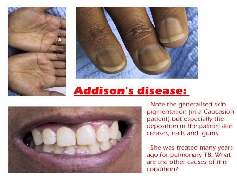 http://www-clinpharm.medschl.cam.ac.uk/pages/teaching/images/addisons.jpg