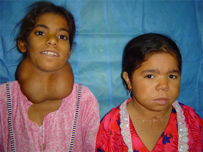 http://www.theijs.com/uploads/congenital_hypothyroidism.jpg