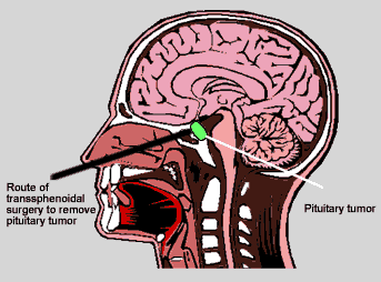 http://www.pituitarysociety.org/public/specific/acromegaly/images/pituitarysurgery.gif