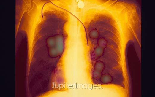 http://www.canceractive.com/cimg/i226__Lung2.JPG