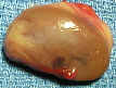 http://www.parathyroid.com/images/gland73.jpg
